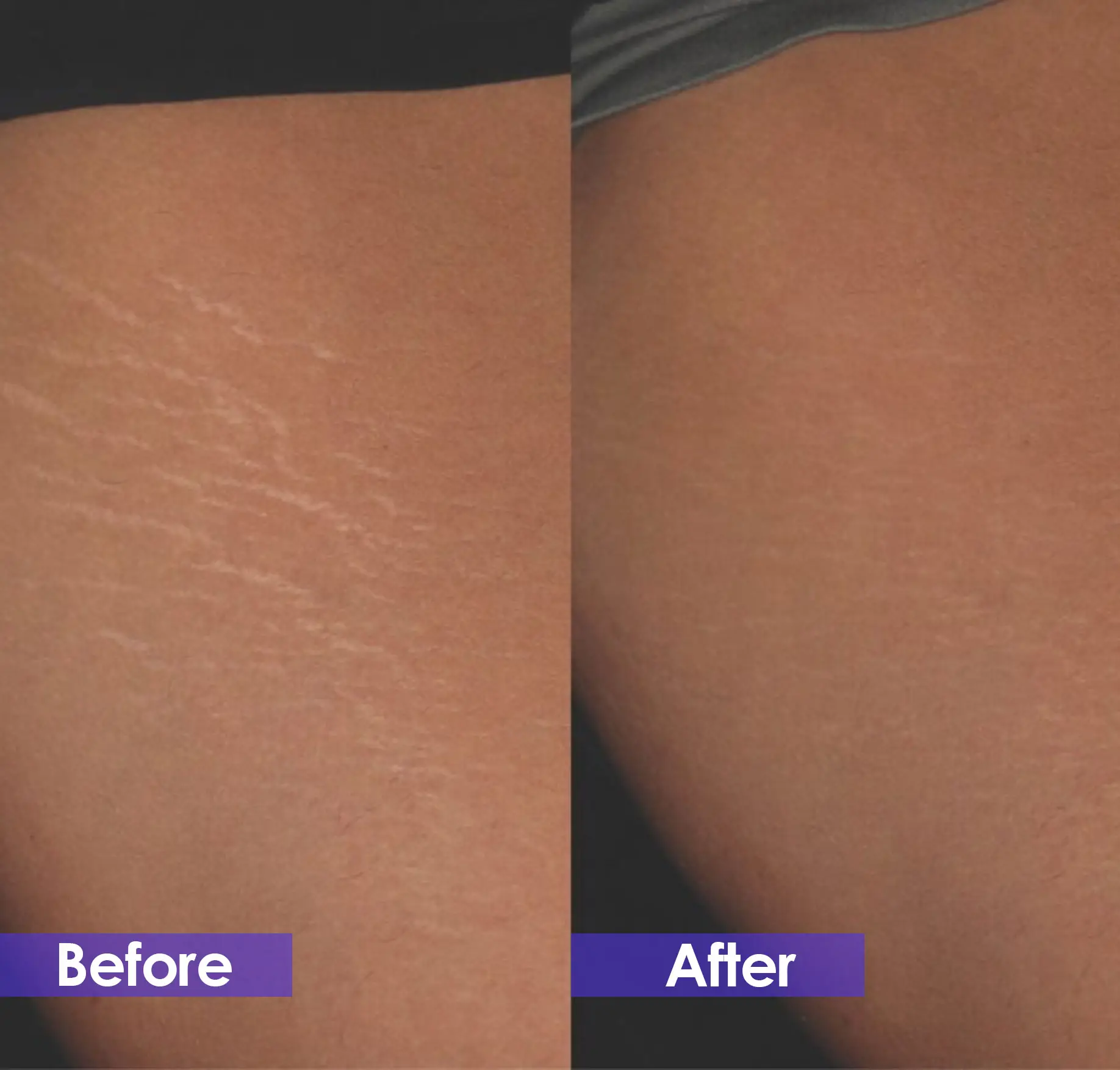 Gold microneedle treatment effect on stretch marks